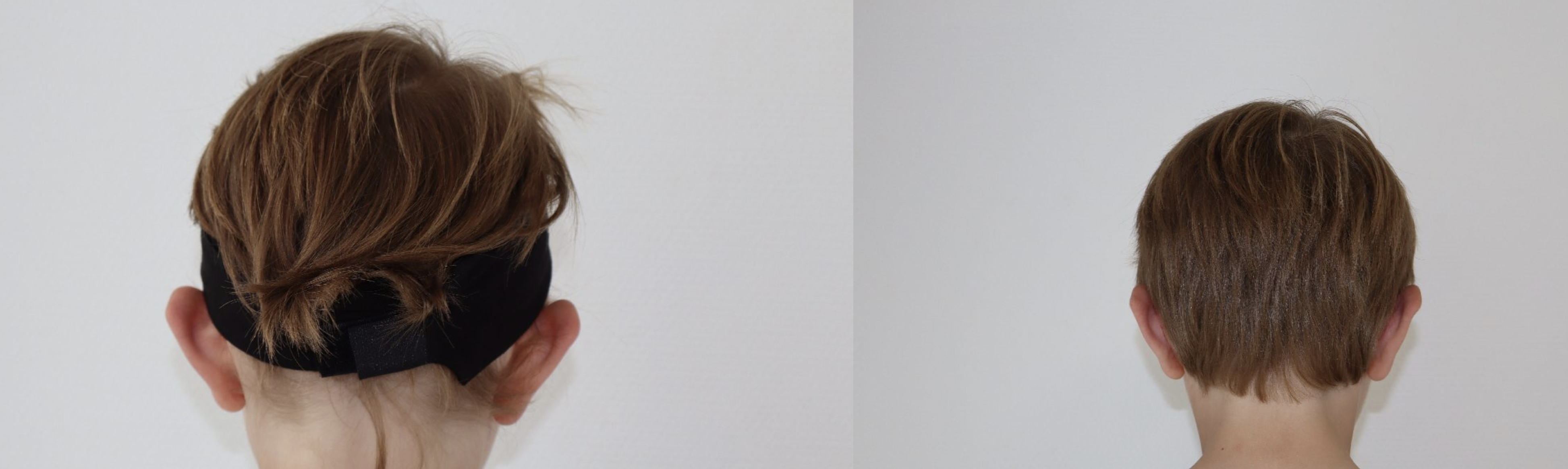 Avant/Après oreilles décollées